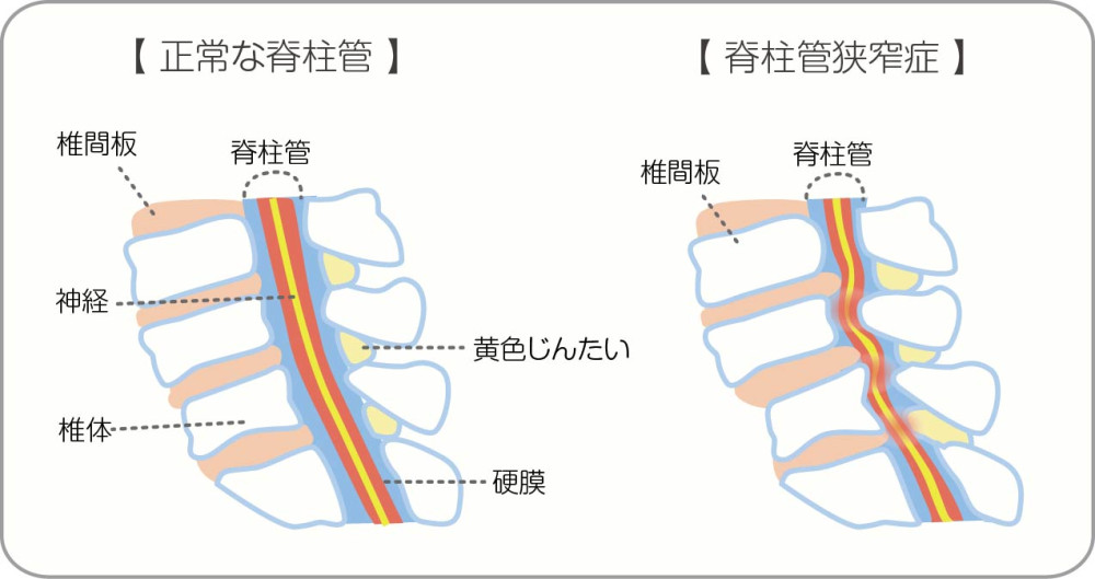 脊柱管狭窄症